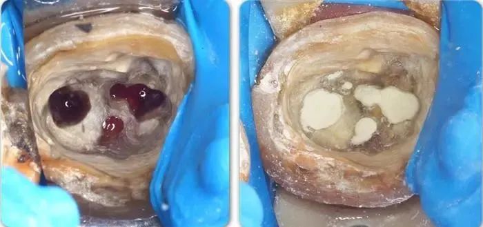 抽神经是什么感觉,抽神经的时候有没有后悔过