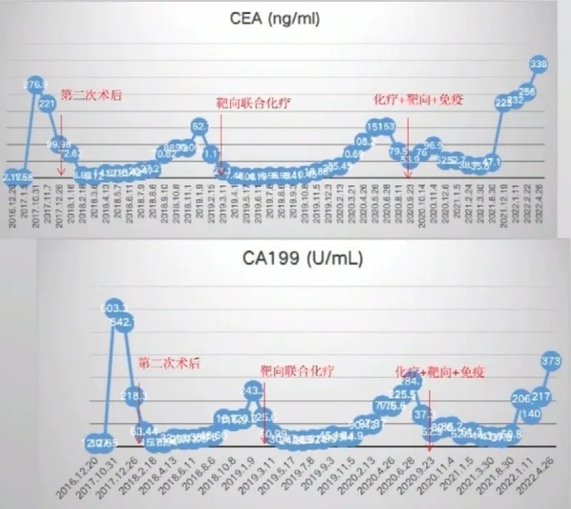 多原发癌症转移,多原发直肠癌