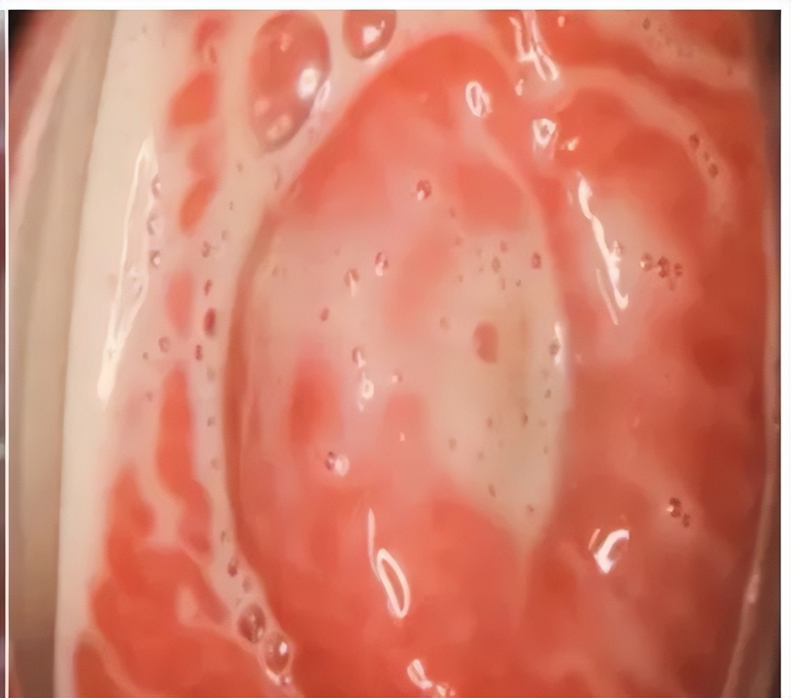 孕期阴道炎最好的治疗方法,孕期阴道炎有什么妙招