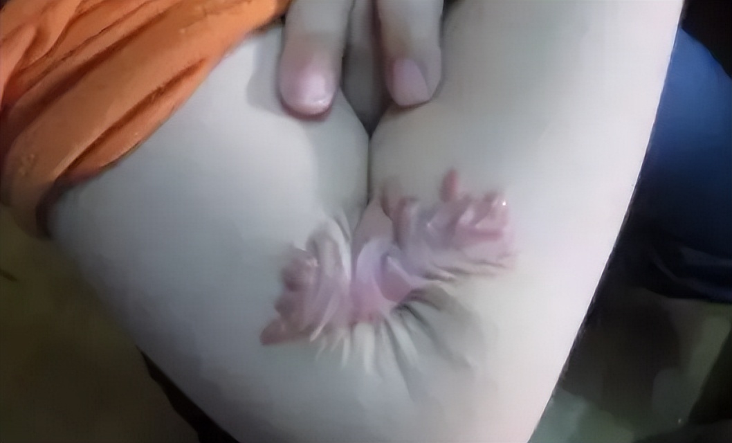 烧烫伤疤痕与硬损伤性疤痕的区别,烫伤疤痕好了可以用芦荟祛疤痕吗