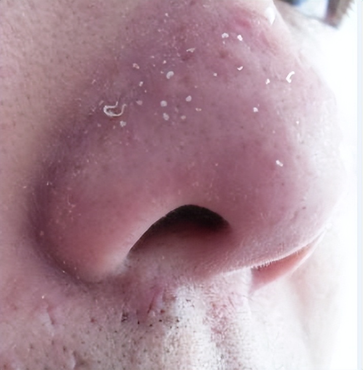 鼻头长黑粉刺怎么回事图片,鼻梁及两侧起了闭口粉刺