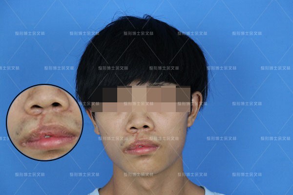 唇裂红唇修复,唇裂手术前后对比图