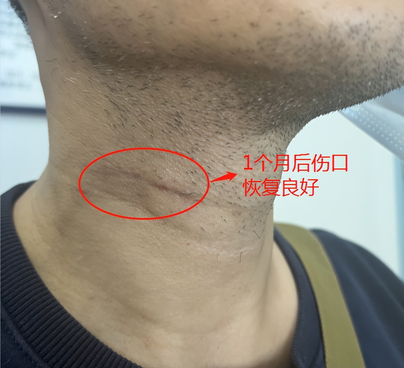 当夜跑爱好者遇上“颈椎病”：颈椎微创手术后多久可以恢复正常？