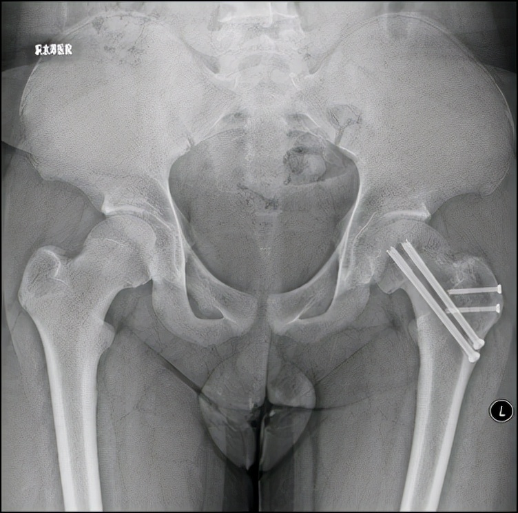 小儿骨科科普类短视频,股骨头骨骺滑脱中医手法治疗