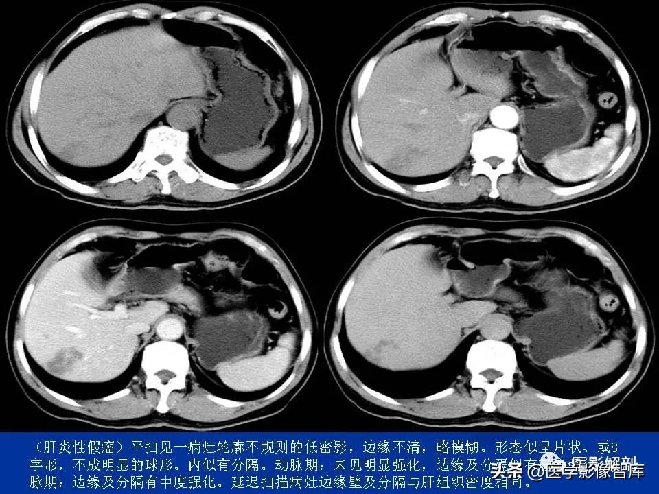 肝炎性假瘤鉴别诊断,肝炎性假瘤影像学表现