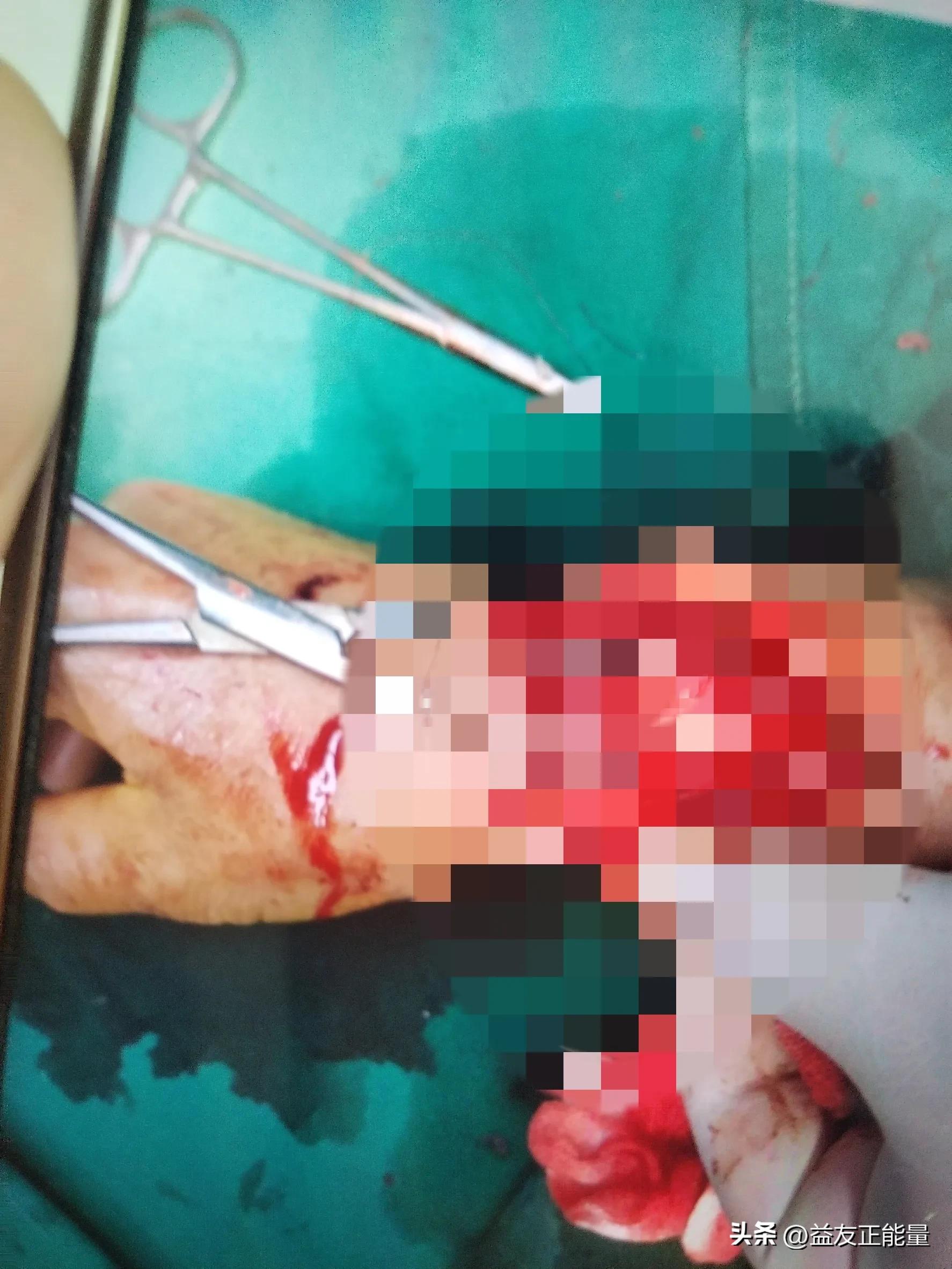 患者去民营医院包扎,被诱进手术室给做了手术,医生说断了二根筋