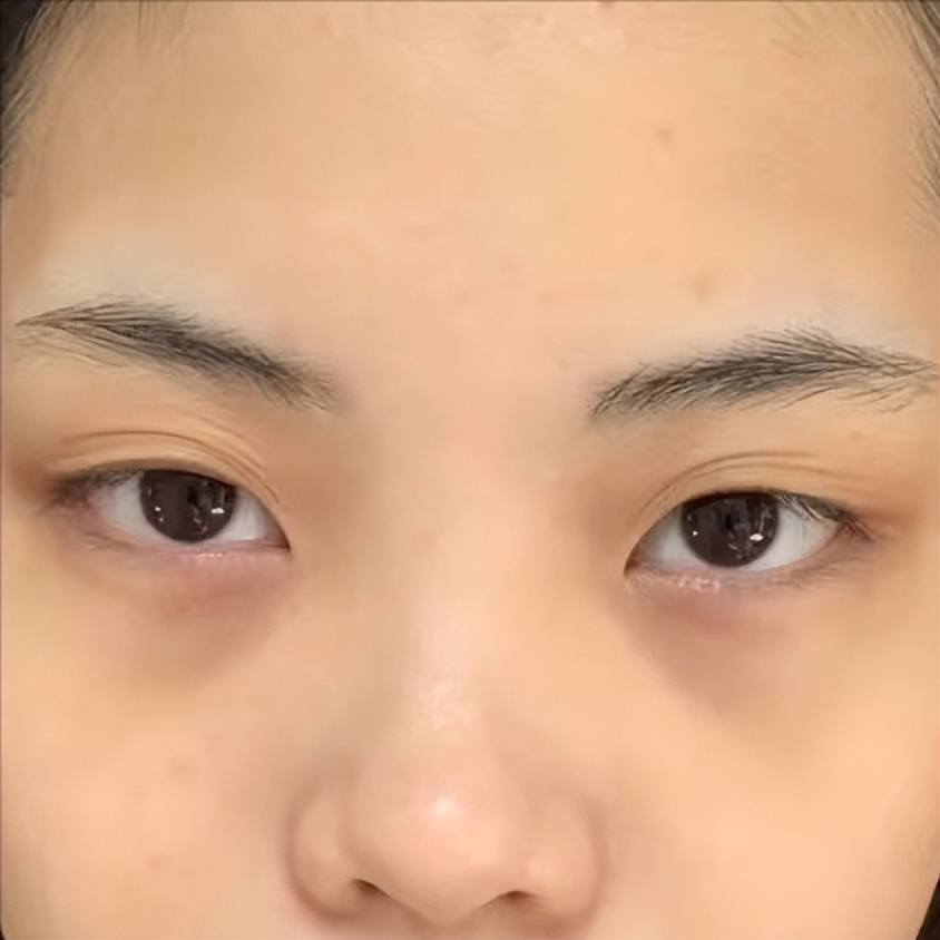 泪沟是凹陷还是下垂,泪沟是什么型的眼袋