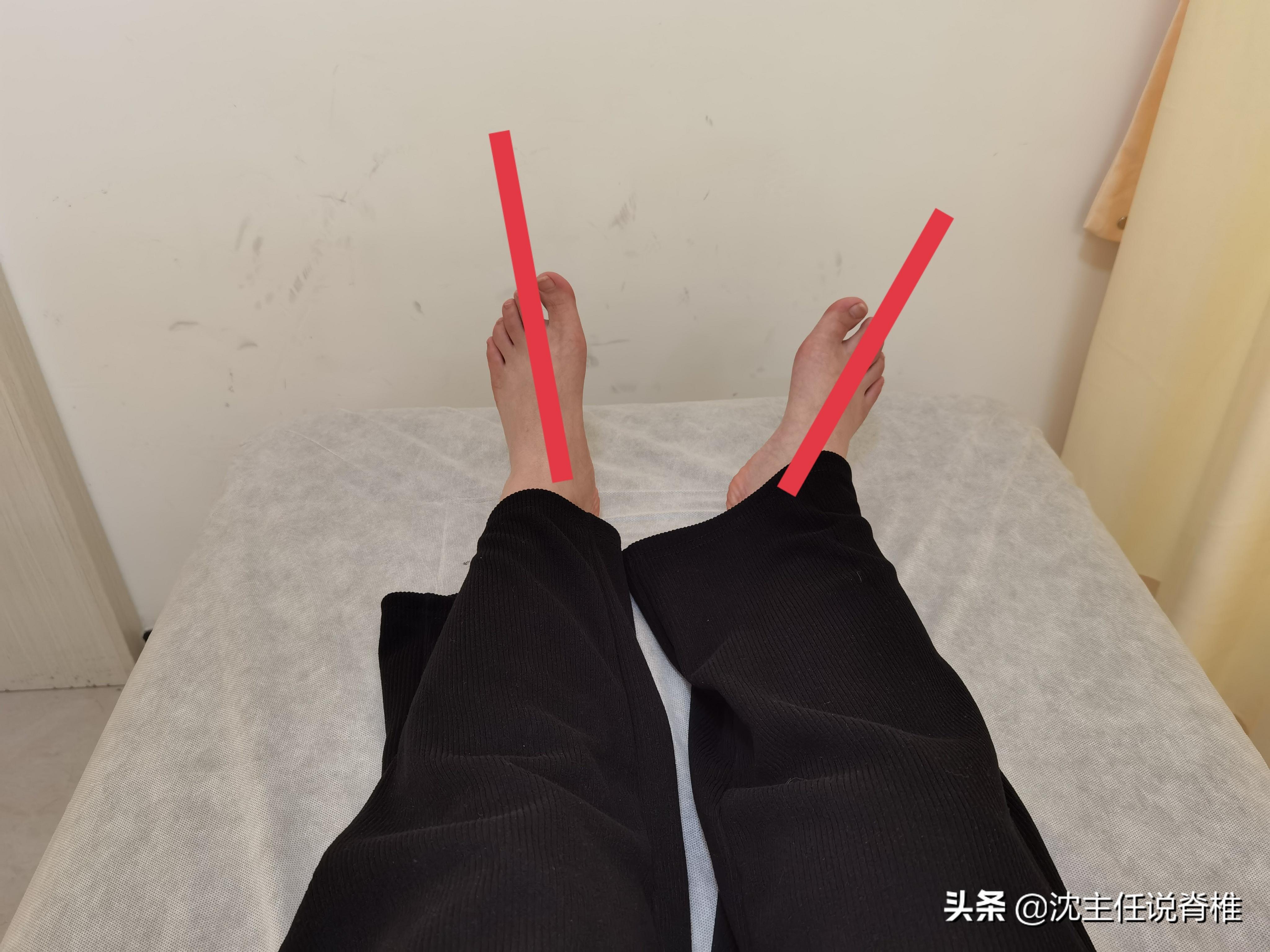 腰骶痛是不是腰突,腰骶疼是腰间盘突出吗