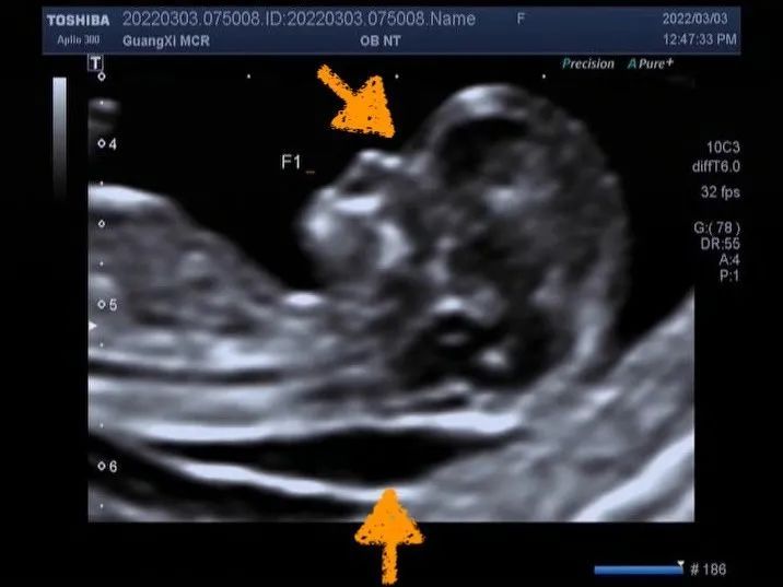 世界唐氏综合症怎么导致的,关于唐氏综合征的这些知识