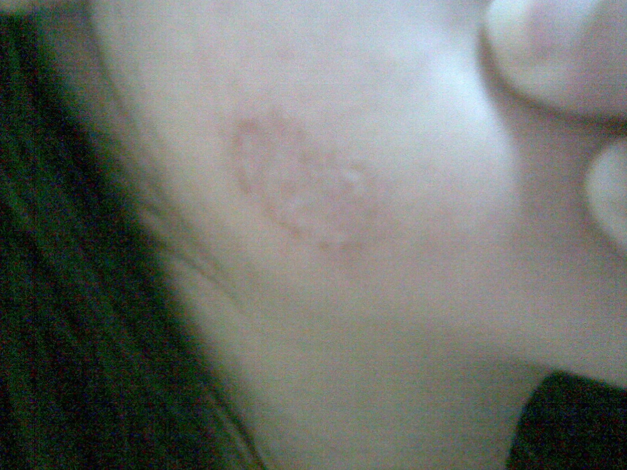 癣和皮炎怎么分辨,癣与皮炎怎么区别图