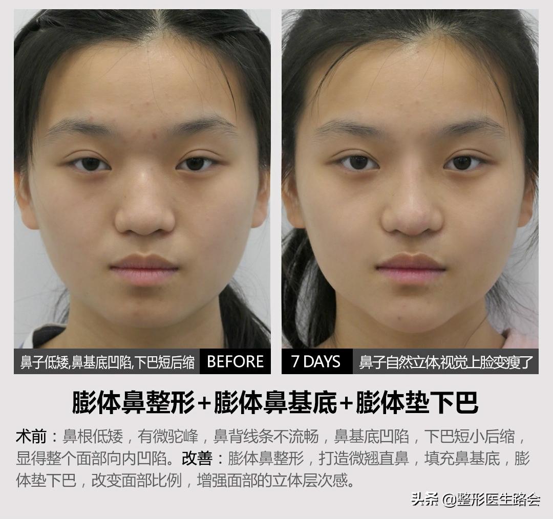 全脸整形记录恢复过程,女孩整形全过程