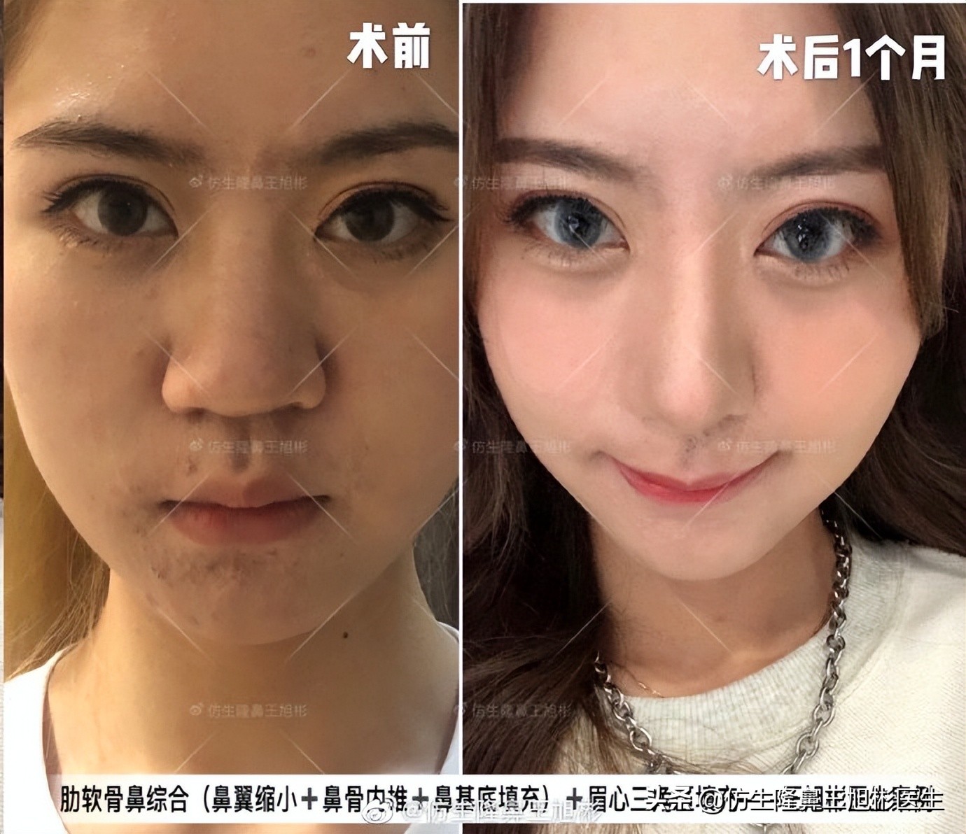 可以只做鼻头不放假体吗,只做鼻头鼻翼缩小手术多少钱