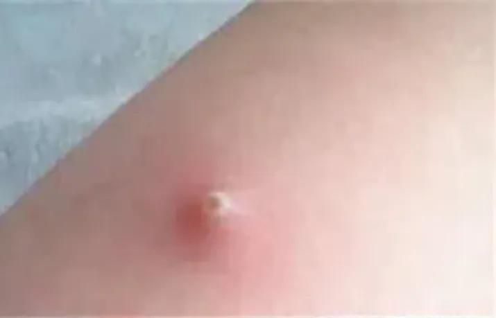 一两块钱的红霉素软膏很实用，能解决多种皮肤问题，早知道早受益