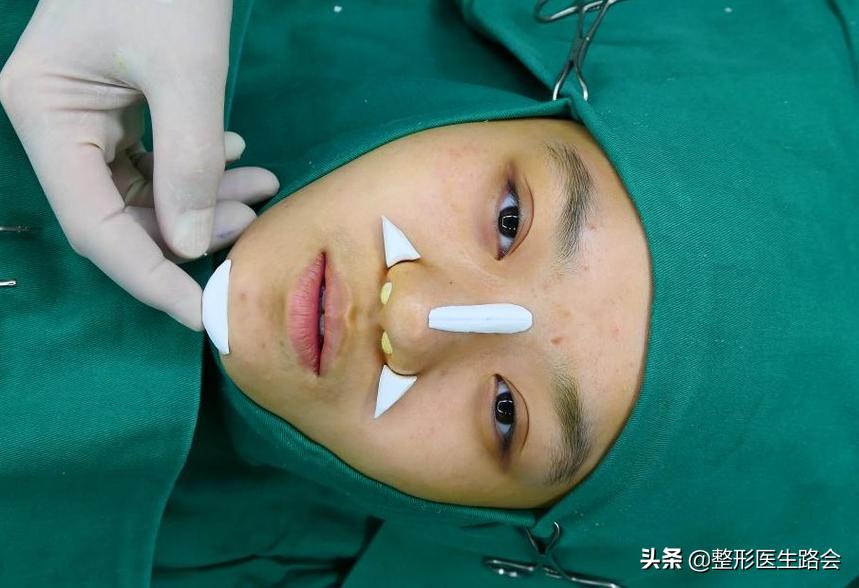 全脸整形记录恢复过程,女孩整形全过程