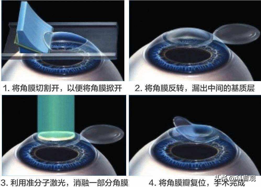 科普关于近视手术的三大谣言,专家揭秘近视手术真相