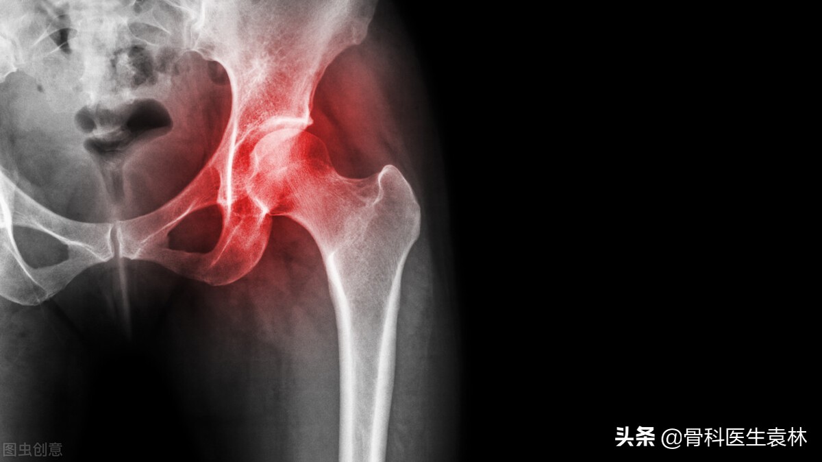 股骨头坏死自测法三大症状要注意,二期股骨头坏死保守治疗症状表现