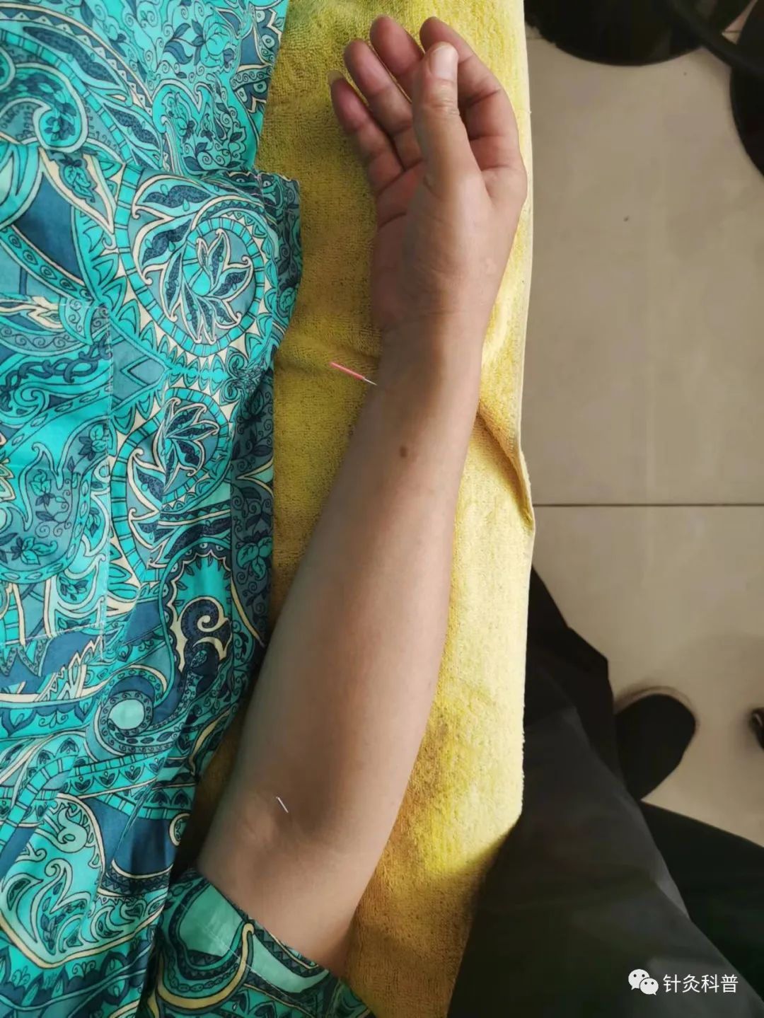 董氏针灸治肾病综合征处方,肾病综合征针灸