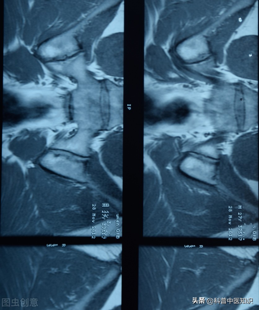 打通督脉强直性脊柱炎的中医疗法,治疗强直性脊柱炎中医还是西医好