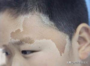 长这种斑小心是癌症信号,哪几种斑容易成癌