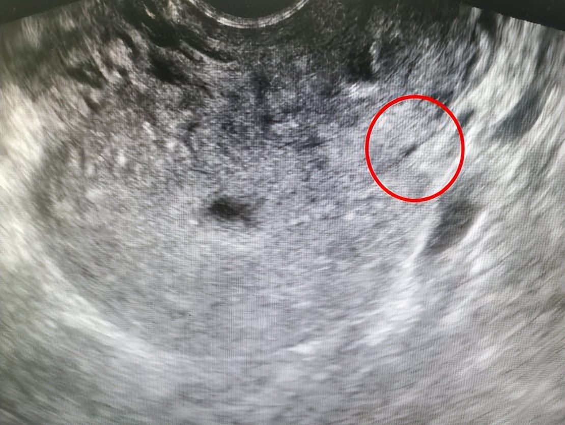 河南23岁宝妈大出血,28岁宝妈吃鸡蛋吃出宫颈癌