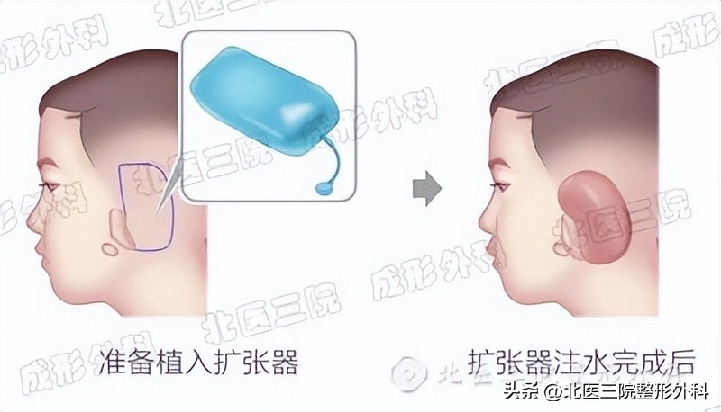 耳廓再造的三个方法,双侧无优势会影响移植吗