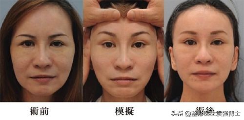 肚皮松弛拉皮手术有副作用吗,脸上做拉皮手术有无副作用