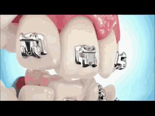 堪比整容式的牙齿矫正,牙齿矫正变美案例