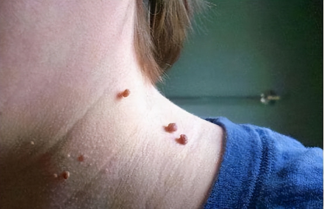 脖子和腋下的小肉粒可以揪掉吗,腋下的小肉粒能揪掉吗