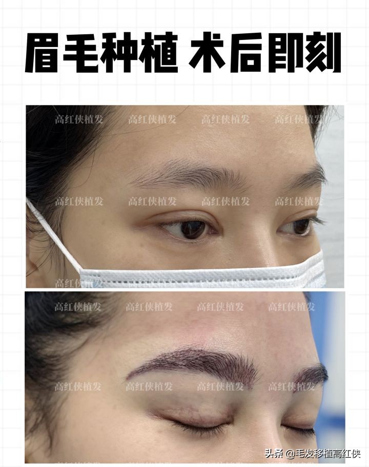 微针植眉技术,生态微针植眉什么时候恢复