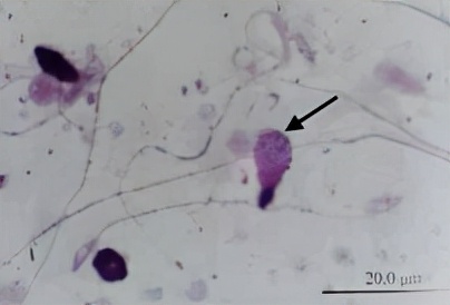 uu感染会自愈么,uu感染是hiv吗