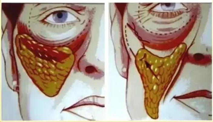 面部平整度是什么意思,怎样提高面部平整度