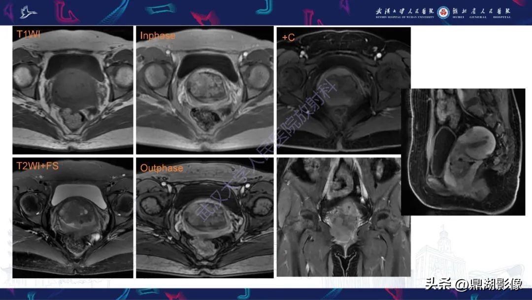 阴道肉瘤症状,阴道肉瘤的早期症状