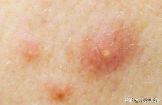 春季室内潮湿细菌感染怎么办,天气热容易霉菌感染用什么药