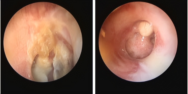 耳骨链断裂手术怎么做,听骨链重建和耳膜修复住院多久