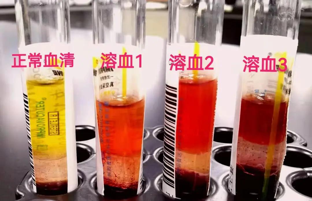 怎么判断采血管溶血,抽血化验溶血需要重新抽怎么回事