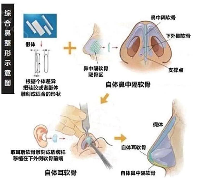 韦敏隆鼻鼻翼缩小,上海韦敏隆鼻案例