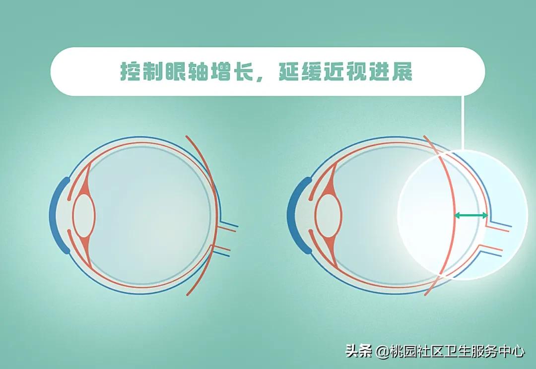 关于近视你应该清楚的几个真相,关于近视这3个误区害人不浅