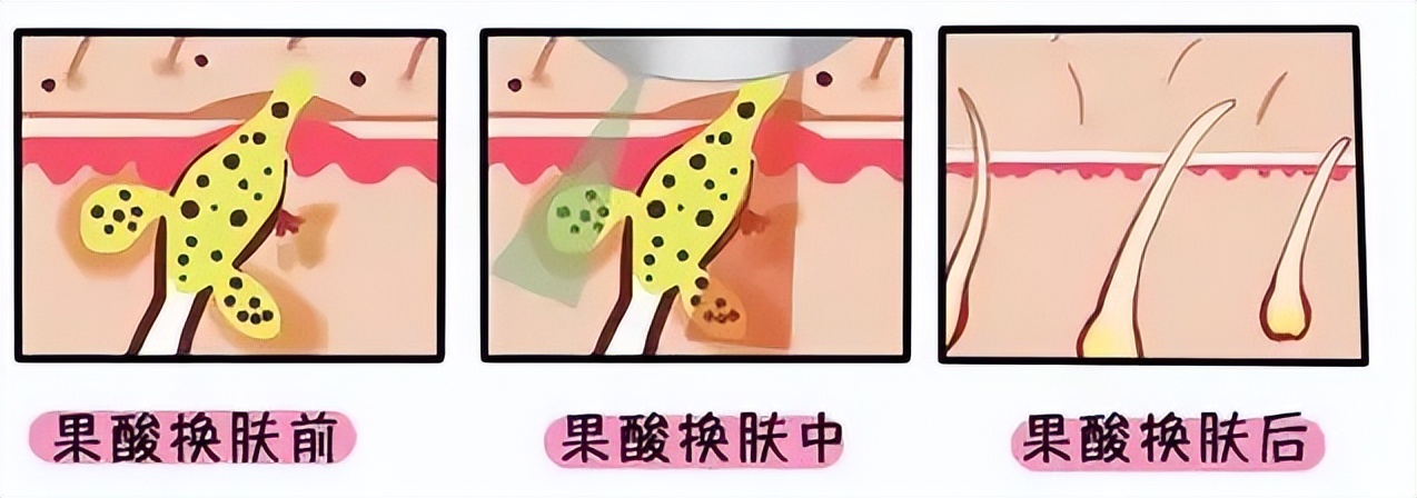 痘痘痘印痘坑改善全过程,学生祛痘痘和痘印痘坑简单的方法