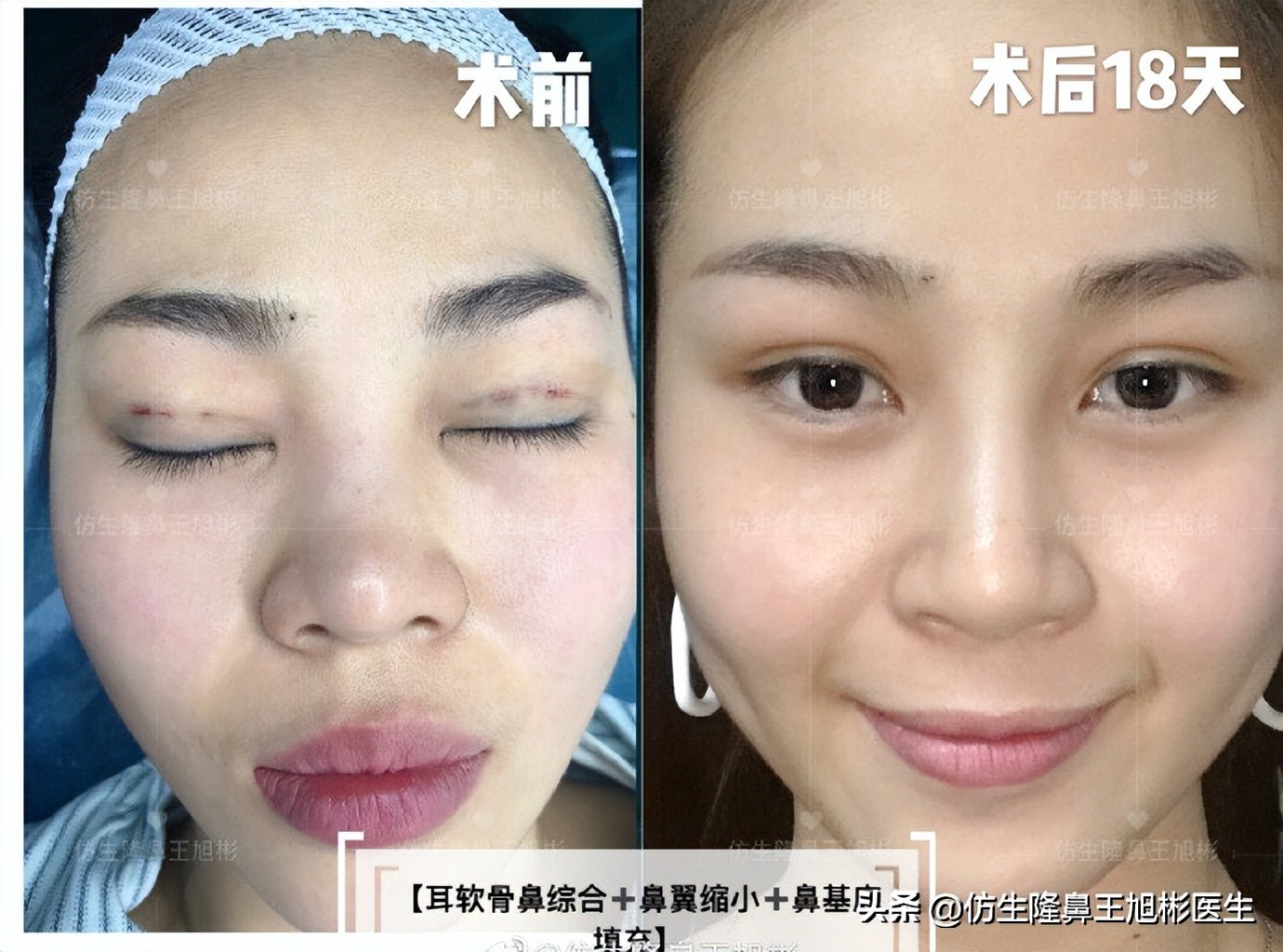 整形鼻部科普知识,隆鼻整形科普知识