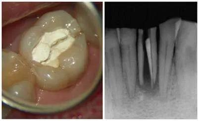 年底牙疼怎么办,春季牙疼是什么原因