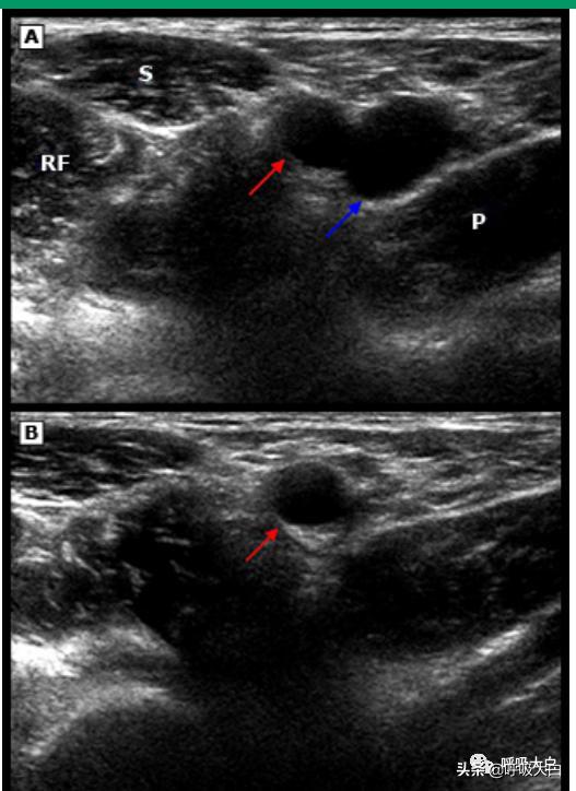深静脉穿刺股静脉步骤,深静脉穿刺置管术视频教程