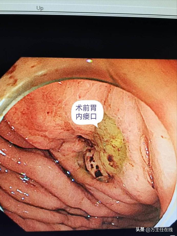 腹腔粘液癌治疗有妙招——万荣教授以内镜Notes技术成功胃减压