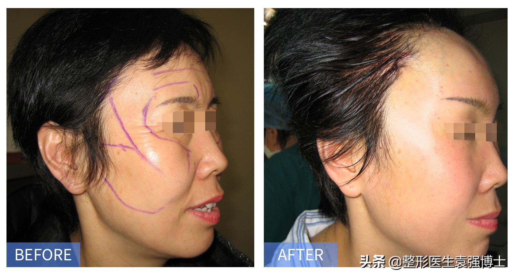 脸下垂松弛提升最好的办法,55岁脸部松弛下垂做什么锻炼紧致