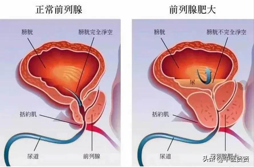 前列腺增生多发结节良性严重吗,良性前列腺增生病人的护理论文