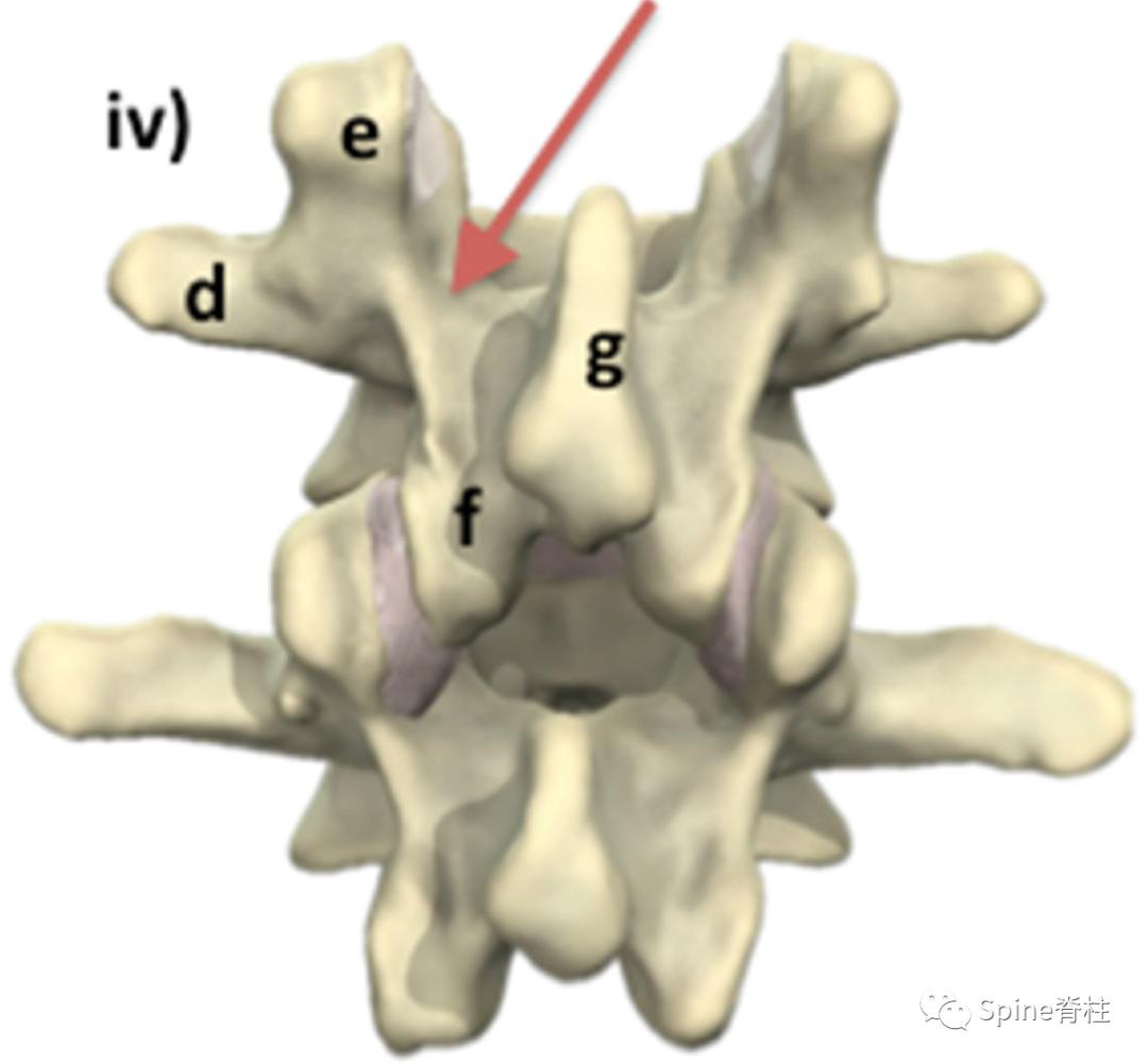 峡部裂和隐性峡部裂有区别吗,单纯峡部裂可以做峡部修复吗
