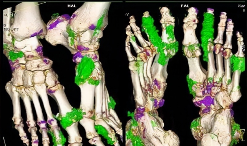 关节痛不要盲目判断滑膜炎,关节疼怎么判定是不是痛风