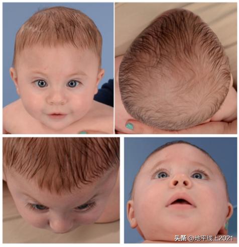 额头上凸起的像犄角一样怎么改善,婴儿额头突出有犄角