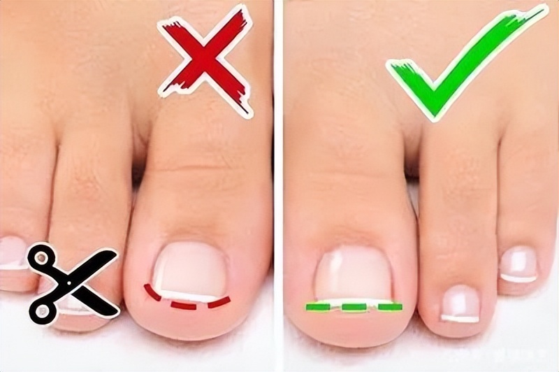 一走路脚趾甲里疼怎么回事,甲沟炎拔完脚趾甲很疼怎么办