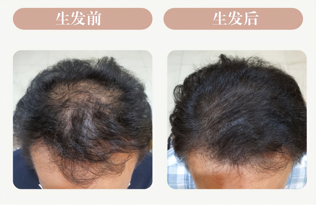 脱发严重要不要植发？有没有更好的治疗方法？