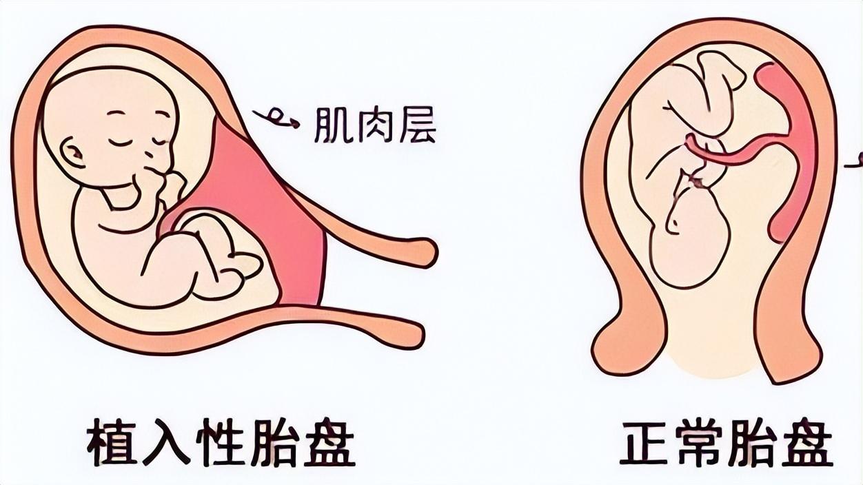 健康女性摘除子宫有影响吗,关爱女性健康不要堕胎